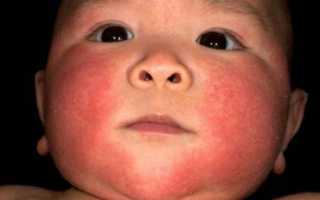Красные пятна на теле у ребенка: основные причины появления и методы лечения