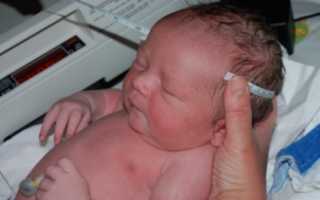 У новорожденного гематома на голове после родов: причины, лечение, последствия