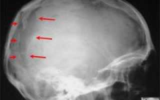 Перелом черепа (Перелом костей черепа)