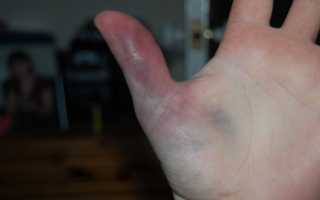 Если ушиб палец на руке: что делать и как лечить в домашних условиях?