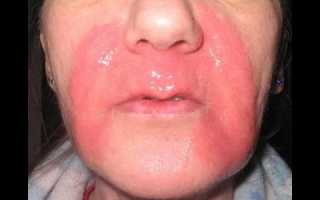 Ожоги на лице: правильное лечение
