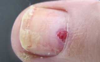 Ушиб ногтя на руке: симптомы, первая помощь, лечение
