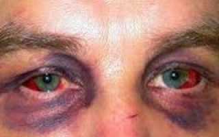 Травма глаз и глазницы. Ушиб глазного яблока и тканей глазницы III-IV степени