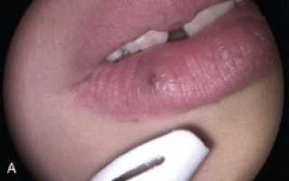 Лечение гемангиомы на губе