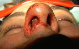 Гематома и абсцесс перегородки носа у детей