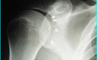 Артроскопия плечевого сустава: показания, операция, реабилитация и инструкция по реабилитации
