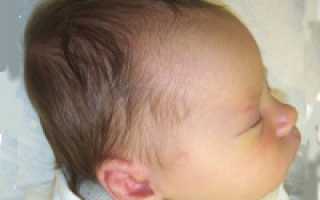 Черепно-мозговые травмы у детей: симптомы, лечение и реабилитация